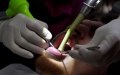 Dental Tourism Boom in Morocco Sparks Safety Concerns Among Spanish Experts