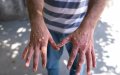 Morocco Heightens Monkeypox Vigilance as WHO Declares Global Health Emergency