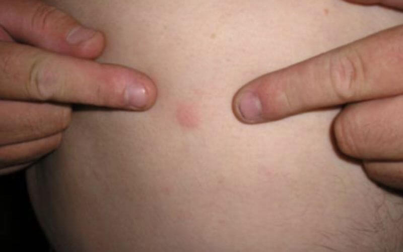 Mysterious Skin Rash Outbreak at Moroccan School Prompts Health Investigation