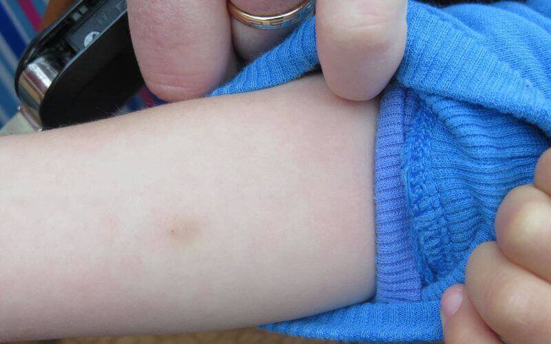 Tuberculosis Surge in Morocco Raises Alarm as Cases Reach 37,000