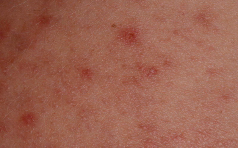 Measles Outbreak in Morocco Sparks Concerns of Imported Cases in France