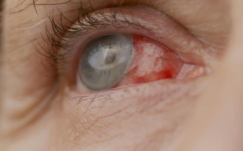 Retired Nurse Charged for Unauthorized Eye Surgery Leaving Patient Blind in Rabat Hospital