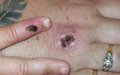 Morocco Implements National Monkeypox Surveillance Plan as Global Cases Rise