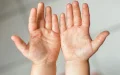 Belgium under tension facing measles imported from Morocco