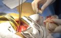 Casablanca Hospital Performs First Successful Living Donor Kidney Transplant