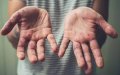 French Tourist Tests Positive for Monkeypox in Marrakech, Morocco