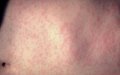 Measles Cases Surge in Southern France, Linked to Moroccan Outbreak