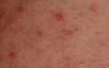 Measles Outbreak in Morocco Sparks Concerns of Imported Cases in France