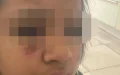 Molenbeek: Camilia, 14 years old, beaten and burned in the face by eight individuals