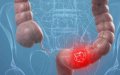 Moroccan Study Suggests Dairy Products May Lower Colorectal Cancer Risk