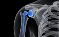 Moroccan Surgeons Perform Region's First Shoulder Replacement at Provincial Hospital
