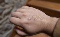 Morocco on High Alert for Monkeypox, No Cases Detected Yet