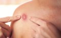 Morocco Reports First Monkeypox Case in Patient from Europe
