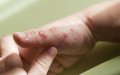 Morocco Seeks Antiviral Drug Tecovirimat to Combat Potential Monkeypox Outbreak