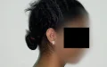 Morocco Teenage Surgery Removes 27% Body Weight Rare Case