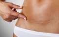 Morocco Tightens Reimbursement Rules for Non-Essential C-Sections