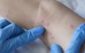 Morocco Unveils National Monkeypox Prevention and Response Plan