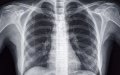 Rare Genetic Condition 'Situs Inversus' Discovered in Moroccan Teen During Appendicitis Exam
