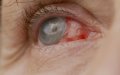 Retired Nurse Charged for Unauthorized Eye Surgery Leaving Patient Blind in Rabat Hospital