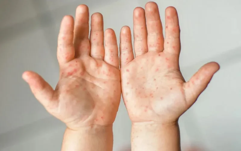 Belgium under tension facing measles imported from Morocco