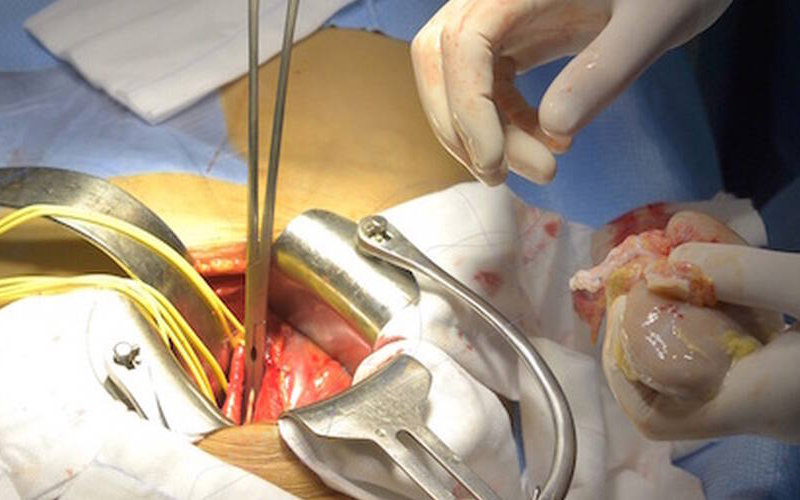 Casablanca Hospital Performs First Successful Living Donor Kidney Transplant