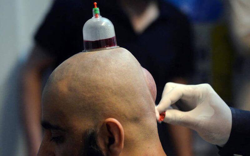 Couple Arrested in Paris Suburb for Illegal Cupping Therapy Practice