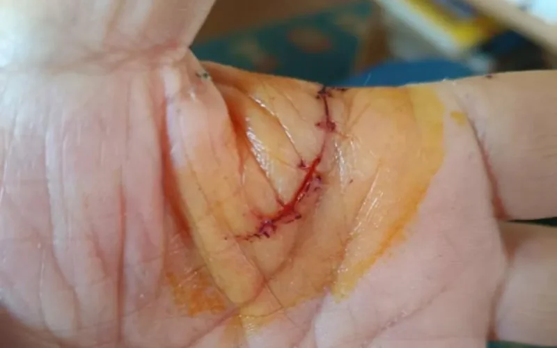 Exploding Wine Bottle: Carrefour Refuses Compensation to Injured Customer