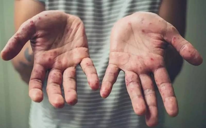 French Tourist Tests Positive for Monkeypox in Marrakech, Morocco