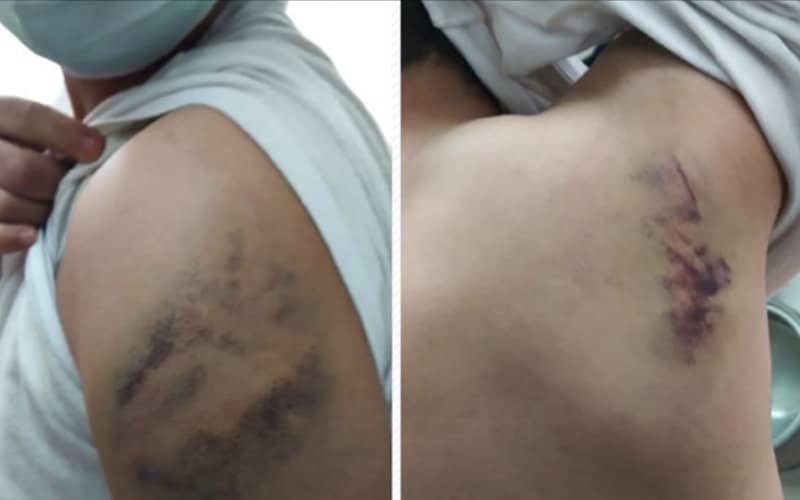 Moroccan Migrant Alleges Police Brutality in Canary Islands Detention Center