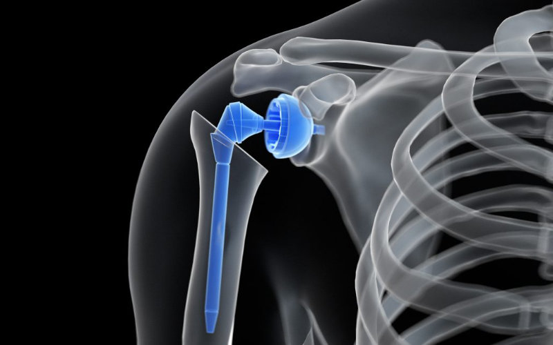Moroccan Surgeons Perform Region's First Shoulder Replacement at Provincial Hospital