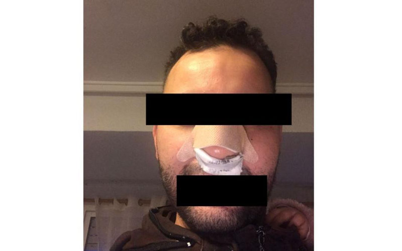 Moroccan Victim Seeks Justice After Brutal Racist Attack at Valencia Nightclub