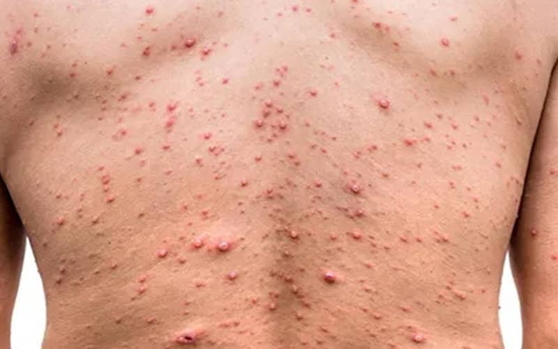 Morocco Implements Monkeypox Alert System as Global Cases Rise
