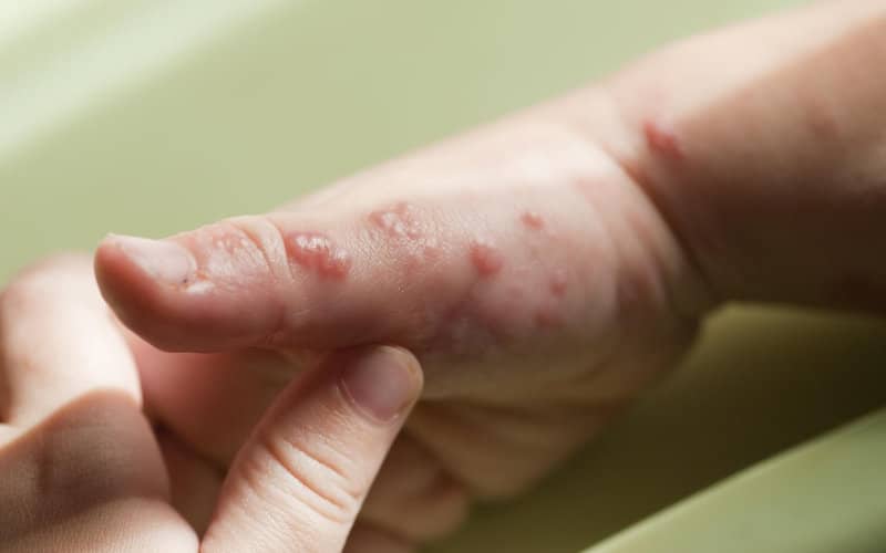 Morocco Seeks Antiviral Drug Tecovirimat to Combat Potential Monkeypox Outbreak