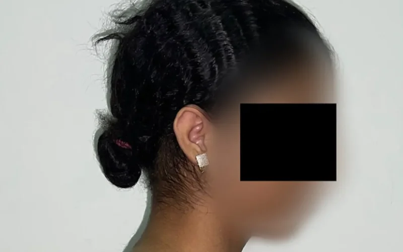 Morocco Teenage Surgery Removes 27% Body Weight Rare Case