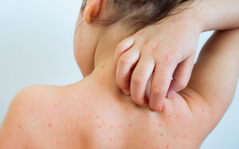 New Measles Variant from Morocco Detected in Brussels Wastewater