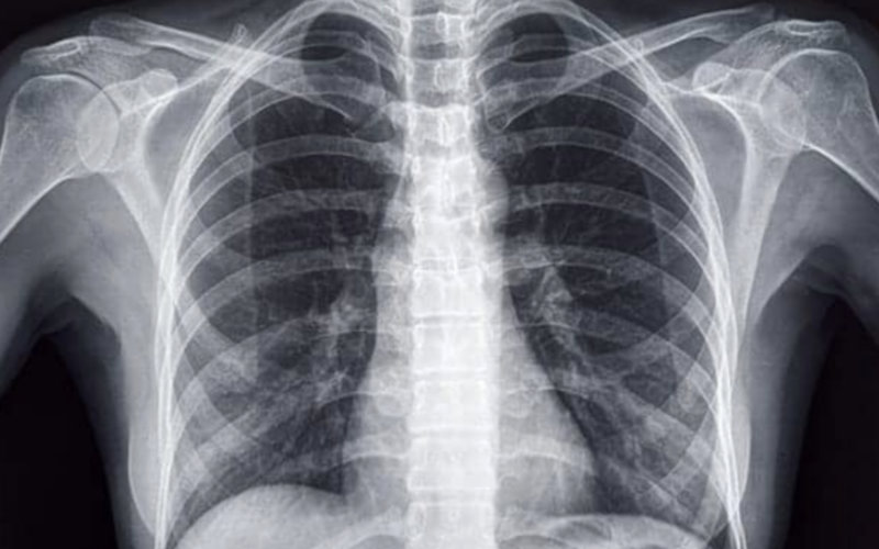 Rare Genetic Condition 'Situs Inversus' Discovered in Moroccan Teen During Appendicitis Exam