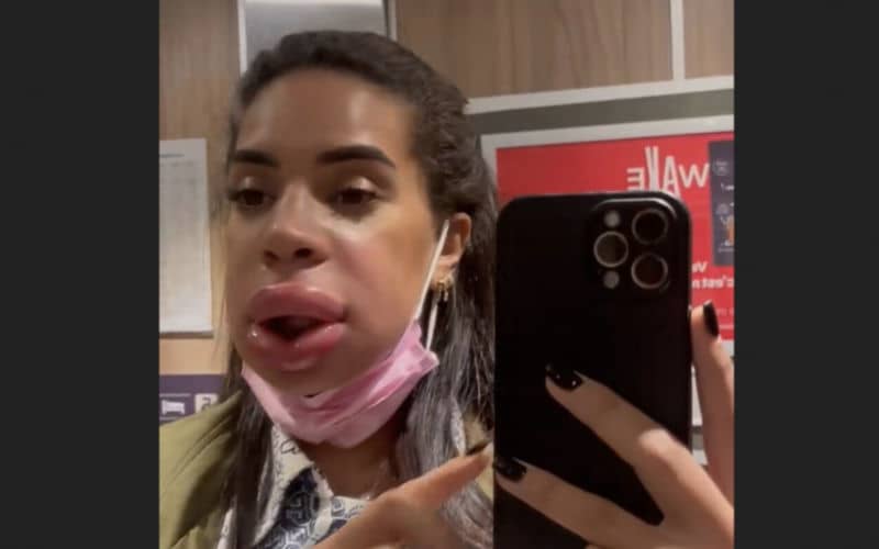 Reality TV Star Marwa Merazka Faces Health Scare After Lip Filler Removal Procedure