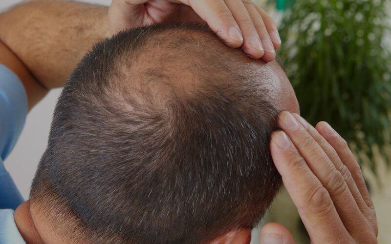 Turkey Emerges as Top Hair Transplant Destination for Moroccan Medical Tourists