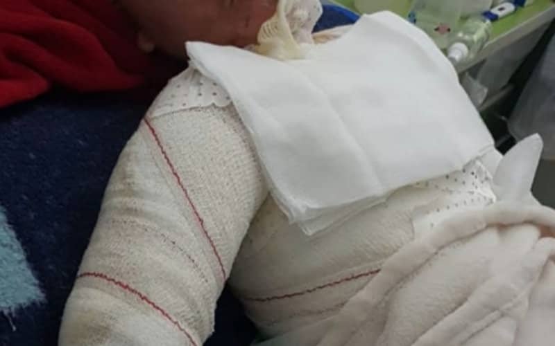 Urgent Fundraiser: 10,000 Euros Needed to Evacuate Severely Burned Moroccan Child to France for Treatment